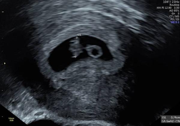 Bild zu 8. Woche - Baby lt. FA zu klein - Schwanger - wer noch? Rund um die Schwangerschaft