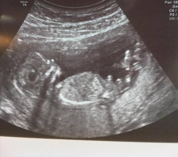 Bild zu Junge oder Mädchen - Schwanger - wer noch? Rund um die Schwangerschaft