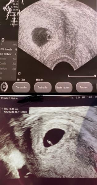 Bild zu Grösse Embryo- wie lese ich das ultraschallfoto - Schwanger - wer noch? Rund um die Schwangerschaft