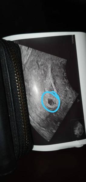 Bild zu Schwangerschaft Blutungen - Schwanger - wer noch? Rund um die Schwangerschaft