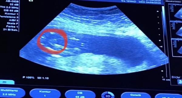 Bild zu Frage Geschlecht... - Schwanger - wer noch? Rund um die Schwangerschaft