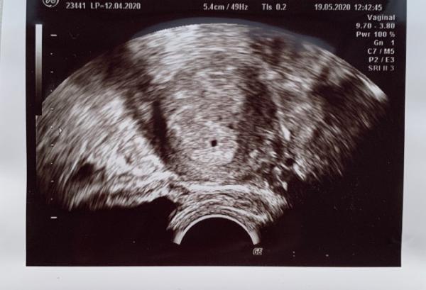 Bild zu 5 SSW - Schwanger - wer noch? Rund um die Schwangerschaft