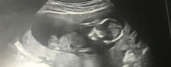 Bild zu Lustiges Nub-Raten - Schwanger - wer noch? Rund um die Schwangerschaft
