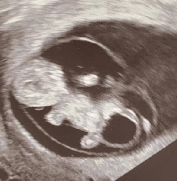 Bild zu Habt ihr sowas schon mal gesehen? Auffälliger Ultraschall - Schwanger - wer noch? Rund um die Schwangerschaft