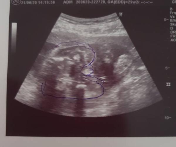 Bild zu Geschlecht ob Junge oder Mädel - Schwanger - wer noch? Rund um die Schwangerschaft