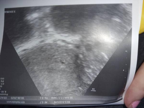 Bild zu Update Angst vor Eileiterss - 5+0 eine 3mm Fruchthöhle - Schwanger - wer noch? Rund um die Schwangerschaft