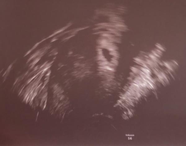 Bild zu SSW6 Ultraschall Bild - Schwanger - wer noch? Rund um die Schwangerschaft