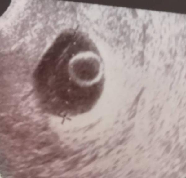 Bild zu 8.Ssw nur Dottersack sichtbar - Schwanger - wer noch? Rund um die Schwangerschaft