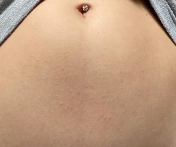 Bild zu Linea Nigra so früh?? - Schwanger - wer noch? Rund um die Schwangerschaft
