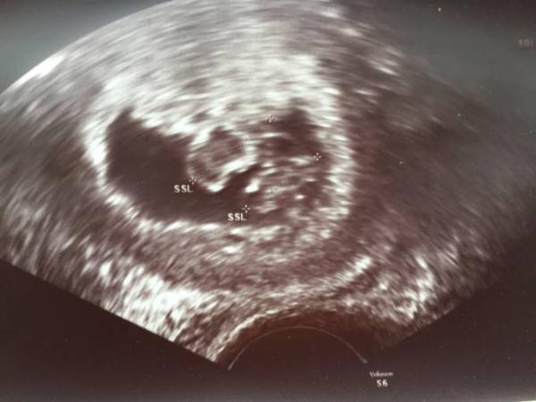 Bild zu Pränataldiagnostik Zwillinge - Schwanger - wer noch? Rund um die Schwangerschaft