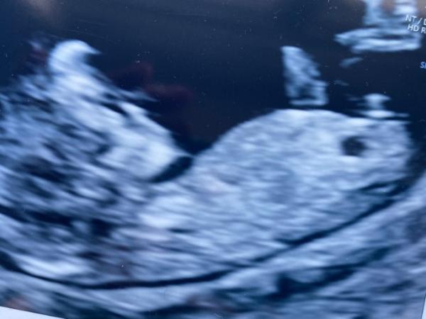 Bild zu NUB - Schwanger - wer noch? Rund um die Schwangerschaft
