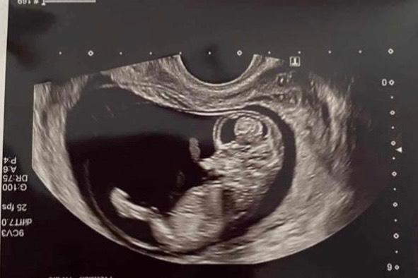 Bild zu Nub oder Skull Theorie. Kennt sich jemand aus? - Schwanger - wer noch? Rund um die Schwangerschaft