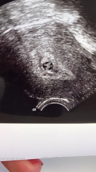 Bild zu Fruchthöhle zu kein für Embryo - Schwanger - wer noch? Rund um die Schwangerschaft