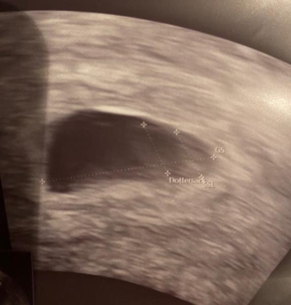 Bild zu Qualität ultraschall / wachstum embryo - Schwanger - wer noch? Rund um die Schwangerschaft
