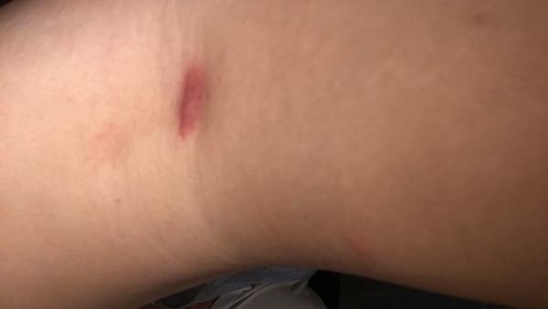 Bild zu Thrombose? Mit foto - Schwanger - wer noch? Rund um die Schwangerschaft