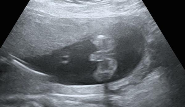 Bild zu Bub oder Mädchen? Tipp? - Schwanger - wer noch? Rund um die Schwangerschaft