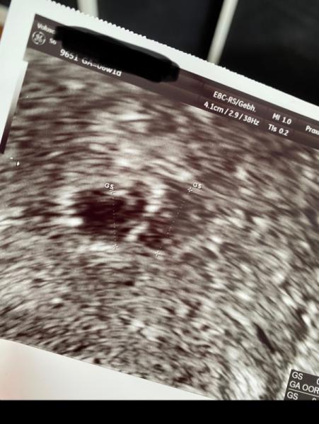 Bild zu Blutungen/drohender Abort - Schwanger - wer noch? Rund um die Schwangerschaft