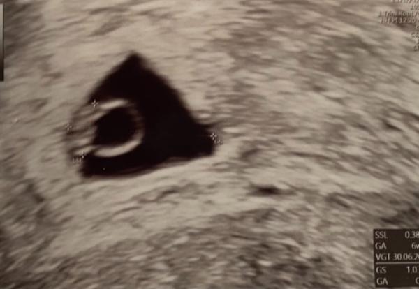 Bild zu Völlig durcheinander đ±đ„° - Schwanger - wer noch? Rund um die Schwangerschaft