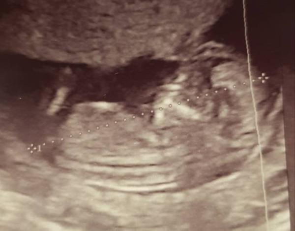 Bild zu Geschlecht 13Ssw - Schwanger - wer noch? Rund um die Schwangerschaft