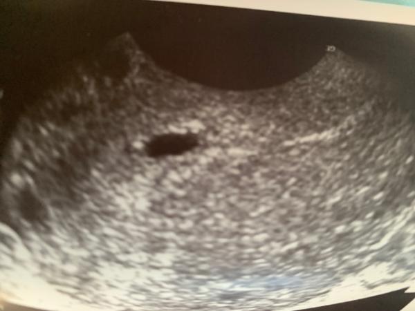 Bild zu Ultraschall 5+6 - Schwanger - wer noch? Rund um die Schwangerschaft