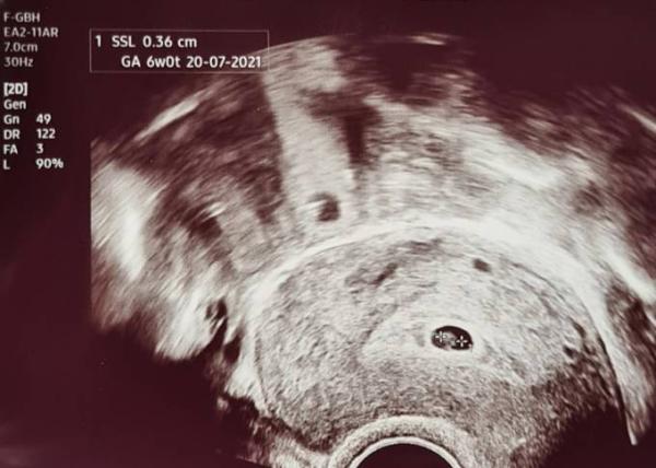 Bild zu Fruchthöhle zu klein embryo normal groß - Schwanger - wer noch? Rund um die Schwangerschaft