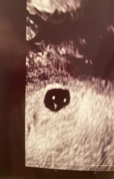 Bild zu Ultraschallbild 6+0 normal ? - Schwanger - wer noch? Rund um die Schwangerschaft