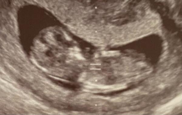 Bild zu Adleraugen, Erfahrungen, Geschlecht - Schwanger - wer noch? Rund um die Schwangerschaft