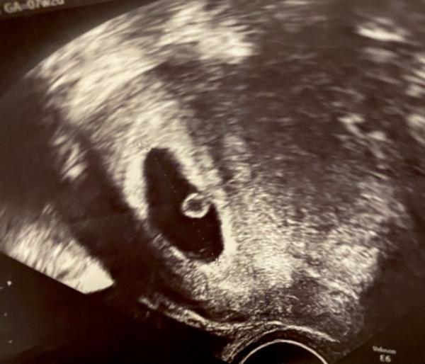 Bild zu Fruchthöhle mit Dottersack, kein Embryo - Schwanger - wer noch? Rund um die Schwangerschaft