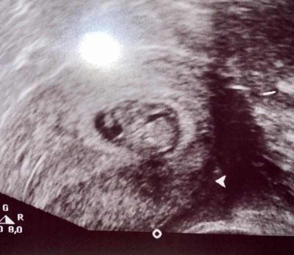 Bild zu Methode zum Geschlechterraten:) - Schwanger - wer noch? Rund um die Schwangerschaft