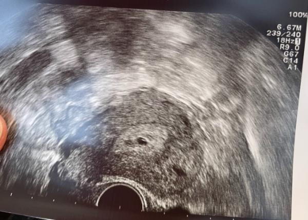 Bild zu Ultraschall 5+2 - Schwanger - wer noch? Rund um die Schwangerschaft