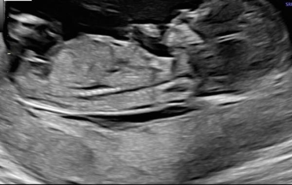 Bild zu Geschlechtsbestimmung in der 14 SSW - Schwanger - wer noch? Rund um die Schwangerschaft