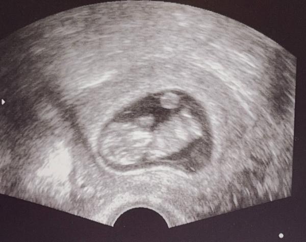 Bild zu FA-Termin 10+2 - Schwanger - wer noch? Rund um die Schwangerschaft
