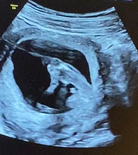 Bild zu Geschlecht des Babys - Schwanger - wer noch? Rund um die Schwangerschaft