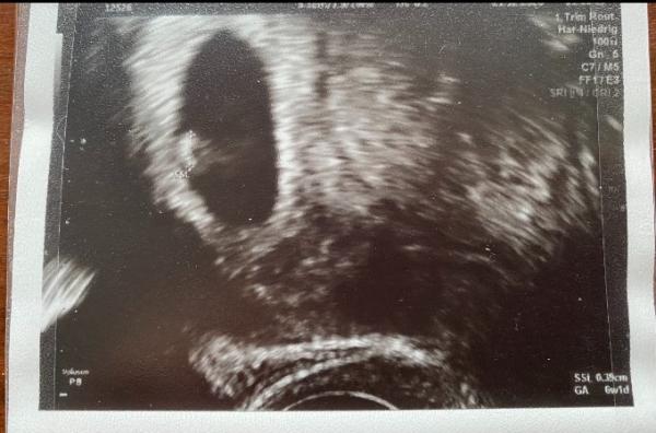 Bild zu RAMZI Methode Junge oder Mädchen - Schwanger - wer noch? Rund um die Schwangerschaft