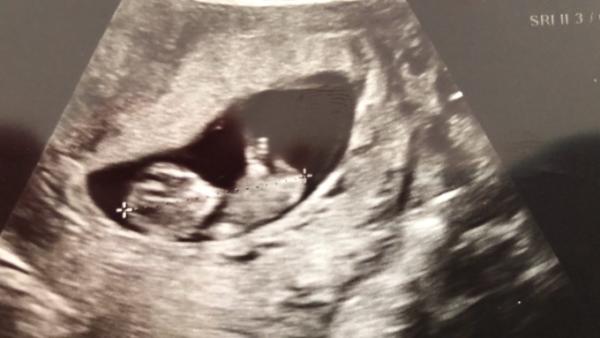 Bild zu Kann jemand das Geschlecht des Babys erkennen - Schwanger - wer noch? Rund um die Schwangerschaft