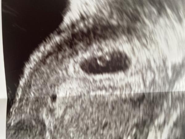 Bild zu Ultraschall 5+5 normal? - Schwanger - wer noch? Rund um die Schwangerschaft