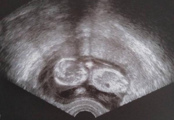 Bild zu Junge oder Mädchen? - Schwanger - wer noch? Rund um die Schwangerschaft