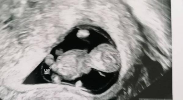 Bild zu Mädchen oder Junge - Schwanger - wer noch? Rund um die Schwangerschaft