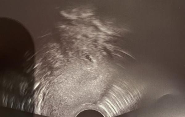 Bild zu SSW 4+2 - Schwanger - wer noch? Rund um die Schwangerschaft