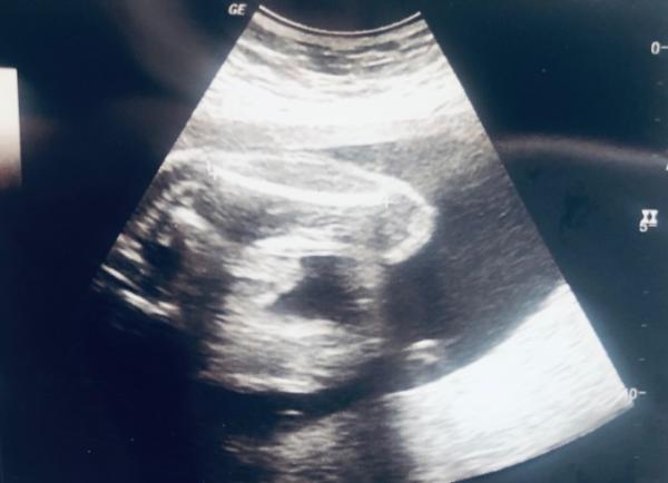 Bild zu Mädchen oder Junge - Schwanger - wer noch? Rund um die Schwangerschaft