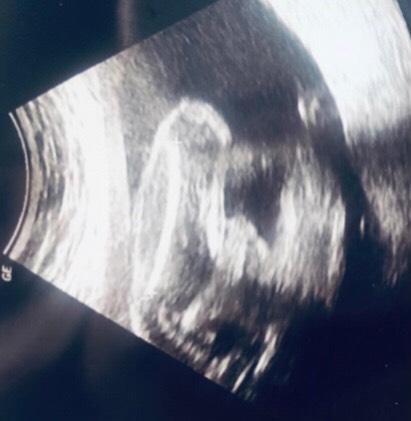 Bild zu Wirklich ein Junge? 👦 - Schwanger - wer noch? Rund um die Schwangerschaft