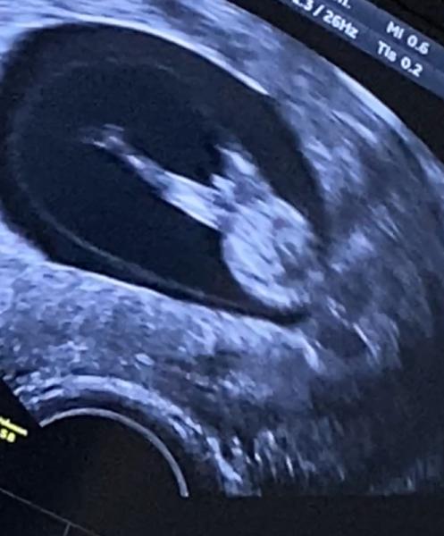 Bild zu Junge oder Mädchen? - Schwanger - wer noch? Rund um die Schwangerschaft