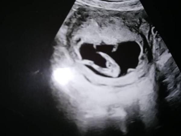 Bild zu Mädchen oder Junge - Schwanger - wer noch? Rund um die Schwangerschaft