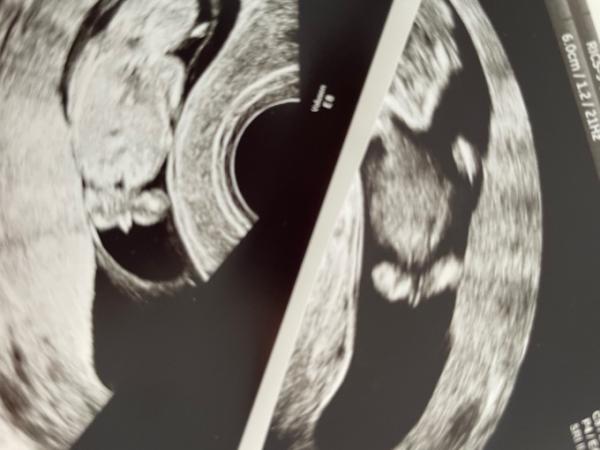 Bild zu Junge oder Mädchen? - Schwanger - wer noch? Rund um die Schwangerschaft