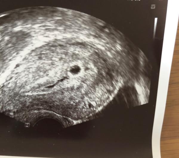 Bild zu Frage wegen US-Bild - Schwanger - wer noch? Rund um die Schwangerschaft