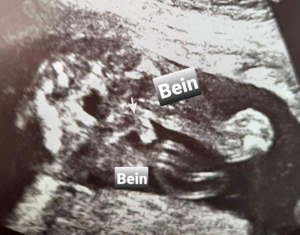 Bild zu Was seht ihr? - Schwanger - wer noch? Rund um die Schwangerschaft