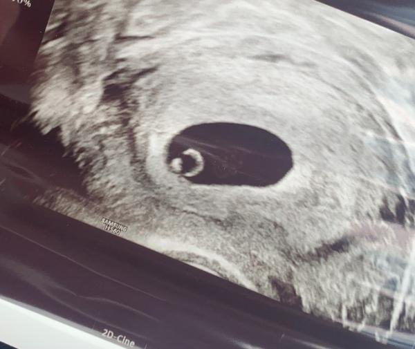 Bild zu Erstes Ultraschallbild , normal? - Schwanger - wer noch? Rund um die Schwangerschaft