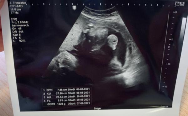 Bild zu Ultraschall / geschlechts erkennen - Schwanger - wer noch? Rund um die Schwangerschaft