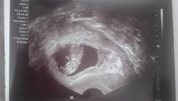 Bild zu NUB Theorie - Schwanger - wer noch? Rund um die Schwangerschaft