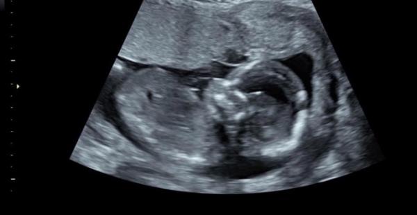 Bild zu Mädchen oder Junge?? - Schwanger - wer noch? Rund um die Schwangerschaft
